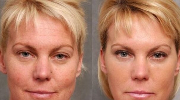Before and after rejuvenation process