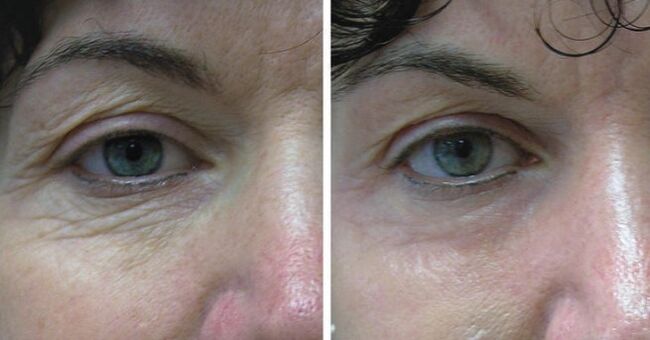 Leather laser around the eyes